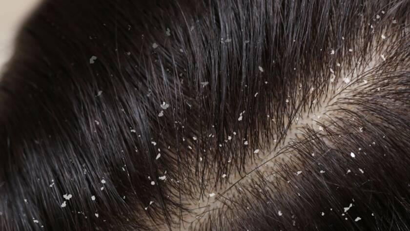 Dandruff on hair