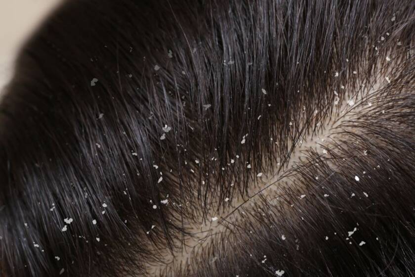 Dandruff on hair