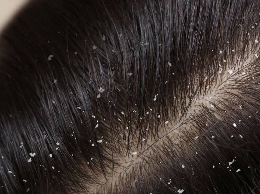 Dandruff on hair