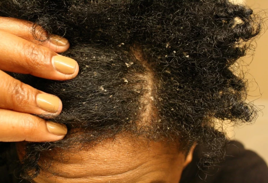 War on Dandruff: Causes, Treatment, and Prevention 1 dendurff